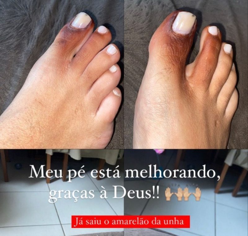 P&eacute; da jovem j&aacute; estava apresentando sinais de melhora na segunda-feira – Foto: Reprodu&ccedil;&atilde;o/Internet