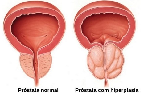 Veja a diferença entre a próstata normal e a aumentada – Foto: Médico Responde