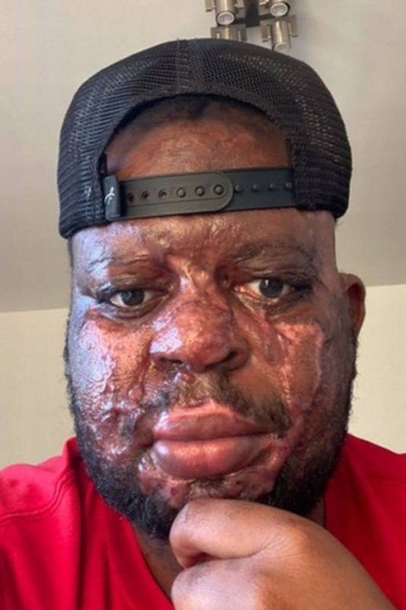 Kelvin Pogo ap&oacute;s ataque com &aacute;cido – Foto: Internet/Divulga&ccedil;&atilde;o/ND