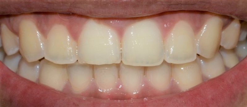 Caso 1 – Antes da cirurgia gengival – Foto: Divulga&ccedil;&atilde;o Bianchini Odontologia