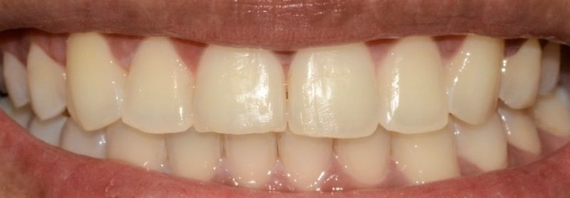 Caso 1 – Depois da cirurgia gengival – Foto: Divulga&ccedil;&atilde;o Bianchini Odontologia