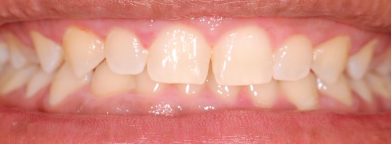 Caso 2 – Antes da cirurgia gengival – Foto: Divulga&ccedil;&atilde;o Bianchini Odontologia