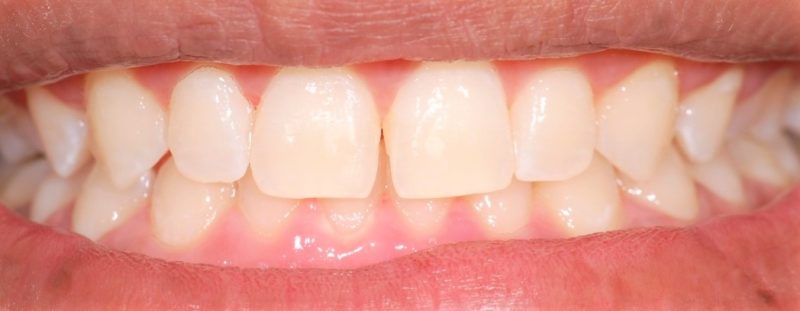 Caso 2 – Depois da cirurgia gengival – Foto: Divulga&ccedil;&atilde;o Bianchini Odontologia