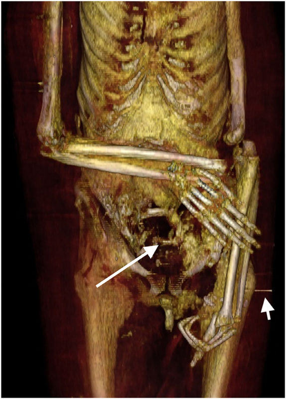 Correções foram feitas no corpo da múmia quando ele foi mumificado pela segunda vez – Foto: Frontiers in Medicine/Divulgação/ND