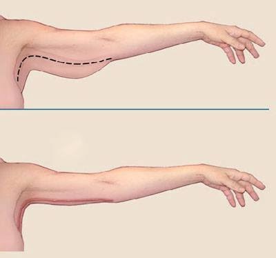 A braquioplastia é indicada para melhorar o contorno dos braços &#8211; Foto: Divulgação Dr. Wagner Santos