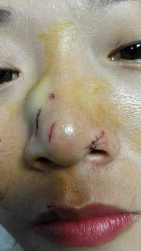 Jovem ficou com rosto deformado após picada violenta de cobra &#8211; Foto: Reprodução/Internet