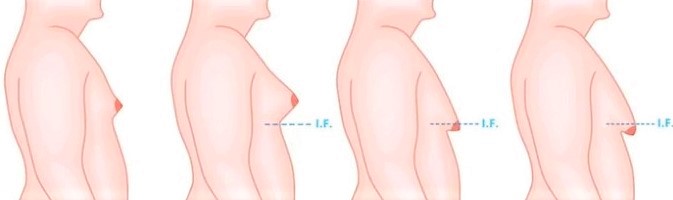 Cirurgia é indicada para homens que tem o tórax com características femininas &#8211; Foto: Divulgação Dr. Wagner Santos