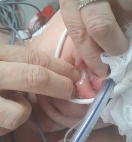 Paciente foi diagnosticada com miíase, quando há infestação de larvas na pele