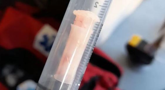 Apito foi expelido durante a reanimação da criança – Foto: CBMSC/Divulgação/ND