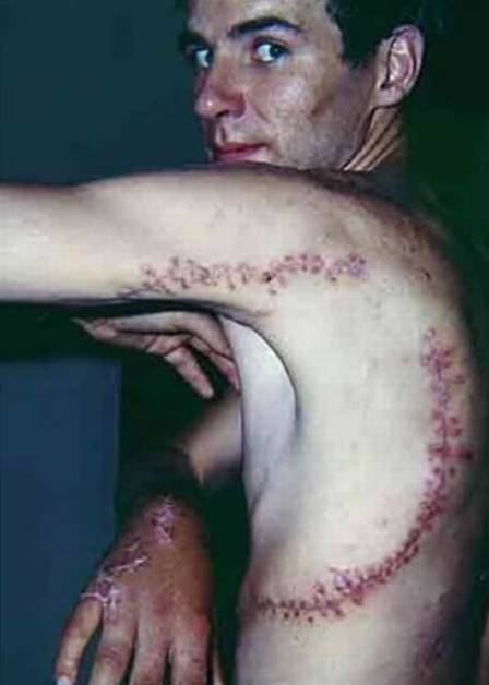 Rodney Fox precisou levar 462 pontos depois de ser atacado por um tubar&atilde;o-branco – Foto: Reprodu&ccedil;&atilde;o/ND