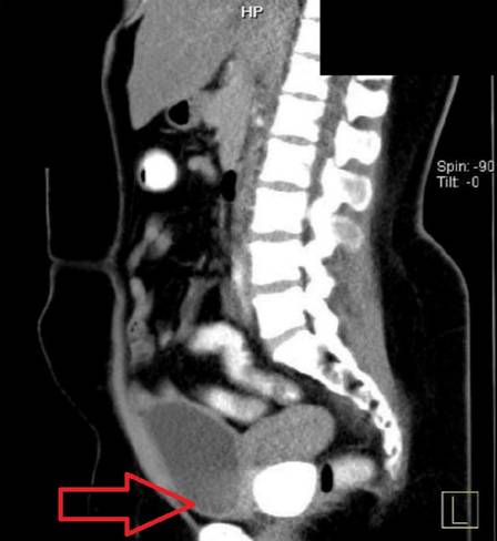 Exame detecta pedras vaginais em paciente na Indon&eacute;sia – Foto: Reprodu&ccedil;&atilde;o/Urology Case Reports/ND
