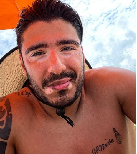 Diego Kydo come&ccedil;ou a falar sobre o vitiligo nas redes sociais – Foto: Divulga&ccedil;&atilde;o/internet