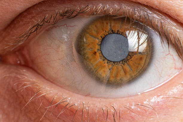 Fique atento à progressão da doença. Olho com catarata tem o cristalino opaco &#8211; Foto: Getty Images/iStockphoto/ND