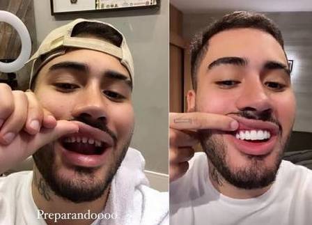 MCC Kevinho &eacute; um dos famosos que aplicou as pr&oacute;teses ultrabrancas – Foto: Reprodu&ccedil;&atilde;o/Internet