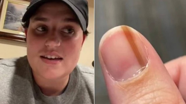 Mulher descobre c&acirc;ncer ap&oacute;s surgimento de mancha escura na unha – Foto: Reprodu&ccedil;&atilde;o/Internet