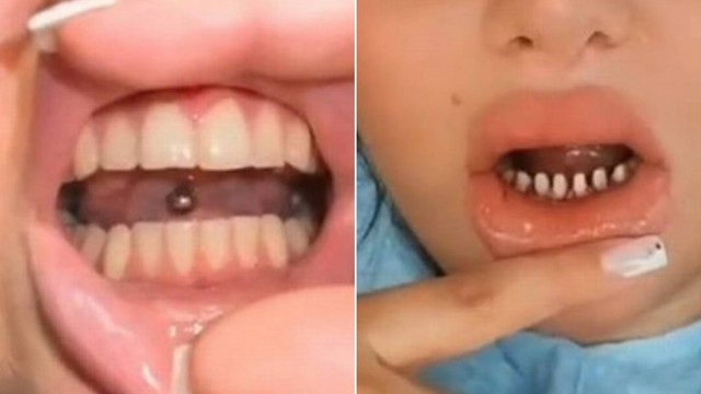 Mulher desgasta dente para torn&aacute;-los perfeitos e dentista rebate: “assassinados” – Foto: Reprodu&ccedil;&atilde;o/Internet