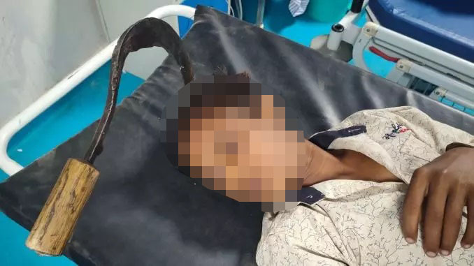 Foice ficou cravada no cr&acirc;nio do adolescente – Foto: Reprodu&ccedil;&atilde;o