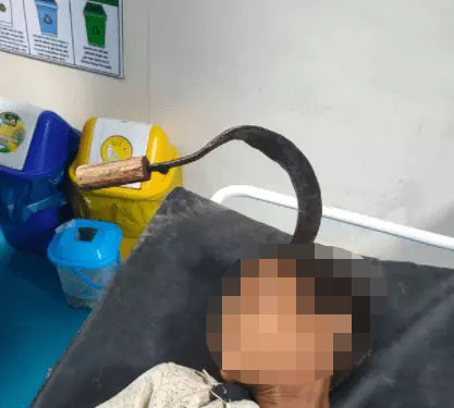 Adolescente teve quatro cent&iacute;metros de perfura&ccedil;&atilde;o na cabe&ccedil;a – Foto: Reprodu&ccedil;&atilde;o