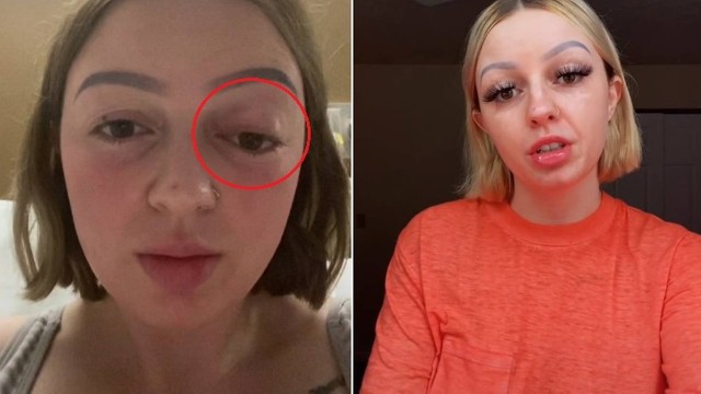 Bethany mostrou como o olho esquerdo sofreu as consequ&ecirc;ncias da for&ccedil;a utilizada durante o parto – Foto: Reprodu&ccedil;&atilde;o/TikTok