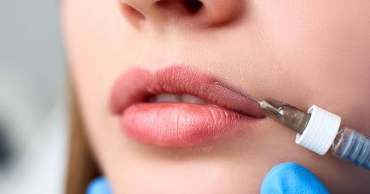 Desarmonizaço e preenchimento labial para voltar a se sentir “natural”