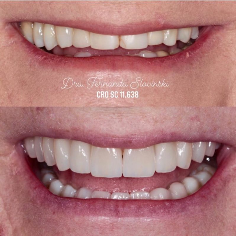 Especialista mostra antes e depois de paciente que ficou com sorriso natural &#8211; Foto: Divulgação