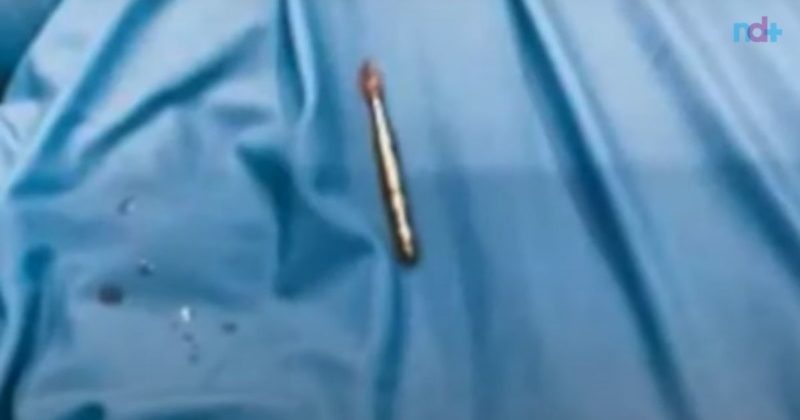 Paciente teve que passar por procedimento cir&uacute;rgico para extrair a broca – Foto: Reprodu&ccedil;&atilde;o