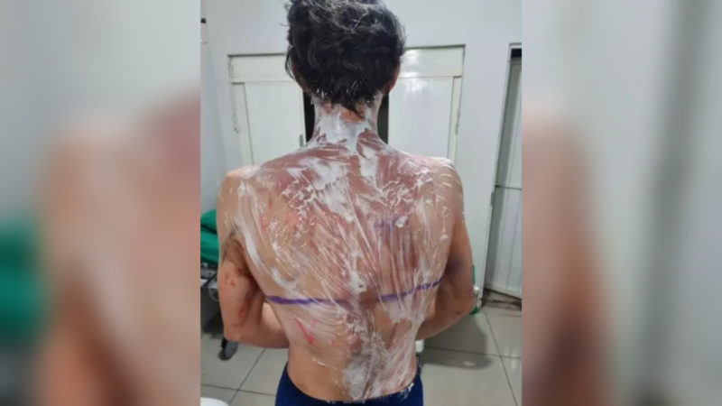 No Paraná, um trote na UFPR deixou 20 calouros com queimaduras graves e virou caso de polícia