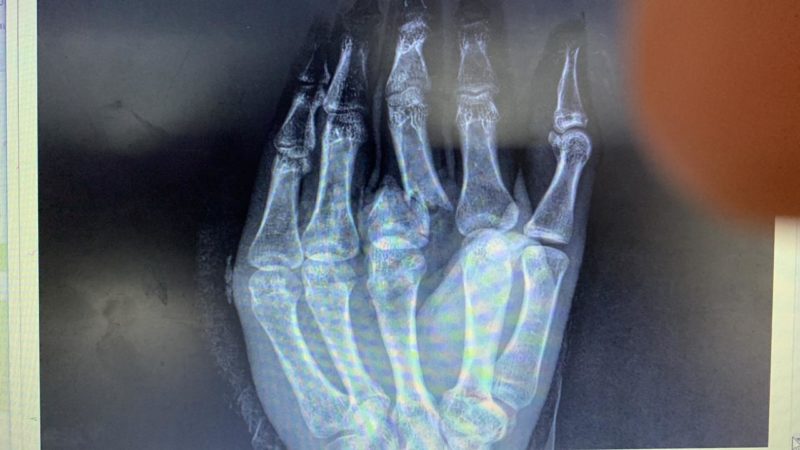 imagens fortes: No raio-X a fratura no dedo médio do skatista Luiz Neto – Foto: @luiznetosk8