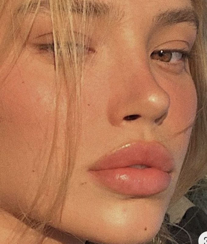 Rinoplastia, um dos procedimentos realizados por cirurgi&otilde;es dentistas em pl&aacute;sticas faciais – Foto: Reprodu&ccedil;&atilde;o/Internet/ND