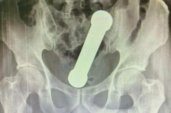 Peso foi visto dentro do homem durante um exame de raio-X – Foto: Reprodu&ccedil;&atilde;o/ND