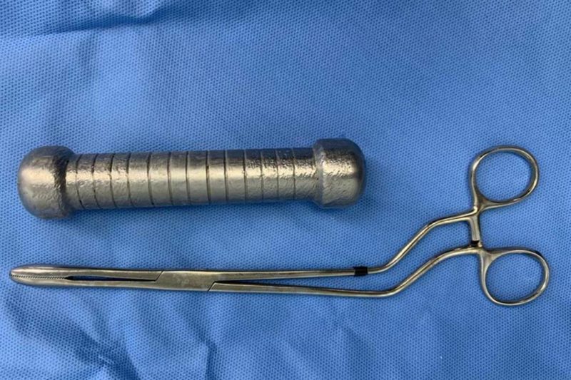 Paciente precisou ser sedado para a retirada do objeto – Foto: Reprodu&ccedil;&atilde;o/ND