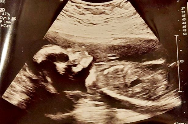 O ultrassom mostrou o feto com uma apar&ecirc;ncia de caveira – Foto: Reprodu&ccedil;&atilde;o/Internet/ND