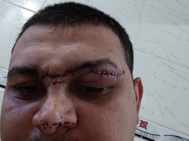 Motociclista leva 30 pontos e quase perde vis&atilde;o em acidente com cerol em Palho&ccedil;a – Foto: Reprodu&ccedil;&atilde;o/NDTV RecordTV