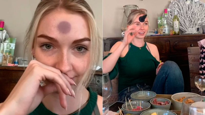 Acidente com brinquedo er&oacute;tico deixa jovem com ‘chup&atilde;o’ na testa – Foto: Internet/Reprodu&ccedil;&atilde;o/ND