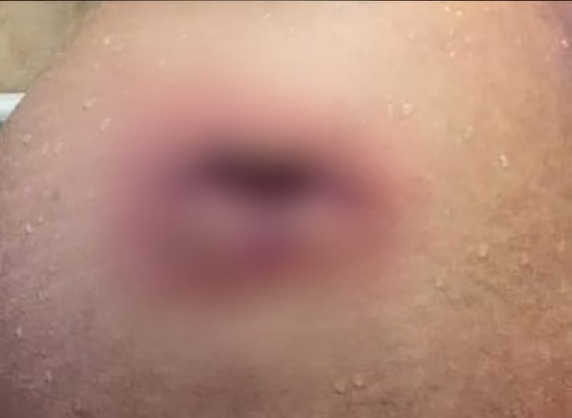 Brit&acirc;nica ficou com um buraco em uma das n&aacute;degas - Divulga&ccedil;&atilde;o/Internet/ND