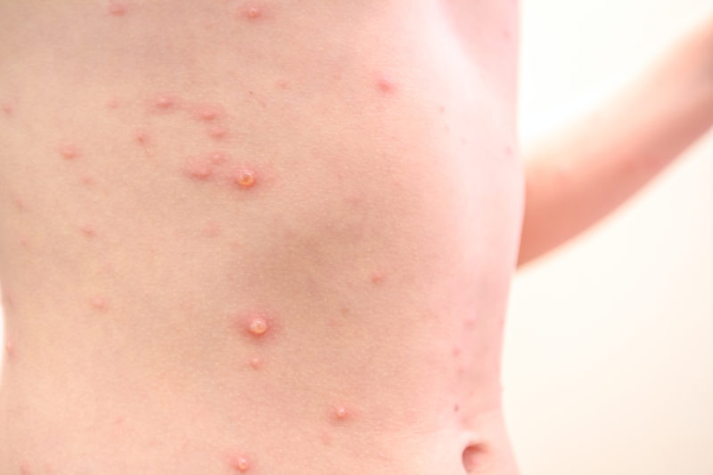 A child with varicella-zoster virus has measles, chickenpox, rubella all over his body.  Viral diseases — Photo: iStock/roman023/ND