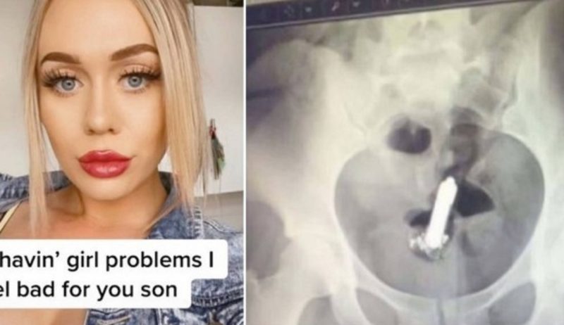 Equipe m&eacute;dica precisou realizar uma pequena cirurgia para retirar o objeto – Foto: Reprodu&ccedil;&atilde;o/Internet