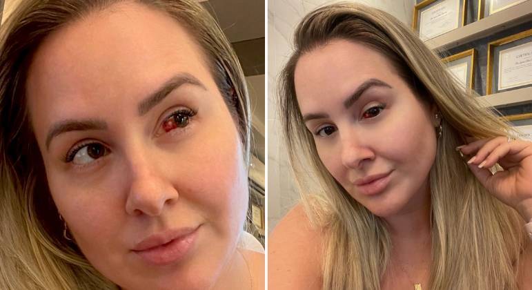 Patr&iacute;cia Leitte revela que sofreu um derrame ocular – Foto: Internet/Reprodu&ccedil;&atilde;o/ND