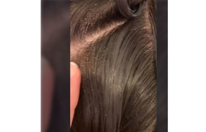 V&iacute;deo do tratamento contra piolho j&aacute; conta com mais de 24 milh&otilde;es de visualiza&ccedil;&otilde;es – Foto: Internet/Reprodu&ccedil;&atilde;o/ND