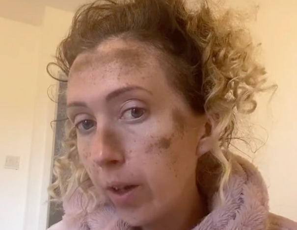 Mulher usou tinta para fazer sardas mas acabou com rosto todo manchado – Foto: Reprodu&ccedil;&atilde;o/TIkTok/ND