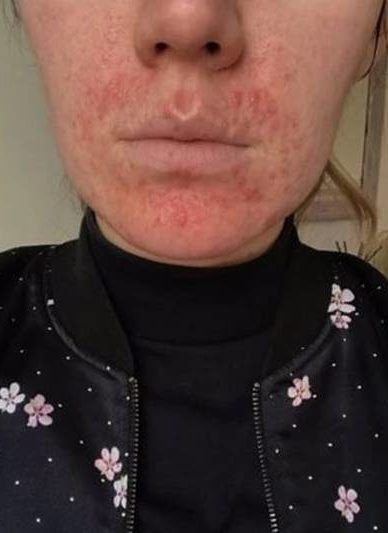 Ela n&atilde;o percebeu que o produto estava vencido e continuou usando o cosm&eacute;tico – Foto: Internet/Reprodu&ccedil;&atilde;o/ND