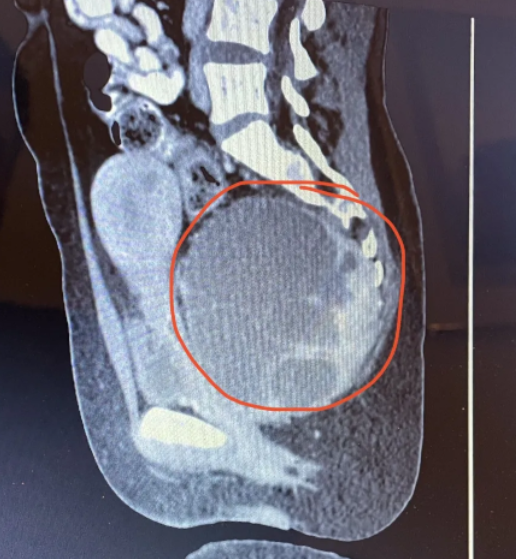 Exame emergencial identificou o gigante tumor na mulher – Foto: Kennedy News/The Sun/Reprodu&ccedil;&atilde;o/ND