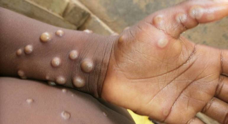 Casos da varíola do macaco foram registrados em países europeus em 2022 &#8211; Foto: Divulgação/OMS/Centro De Controle de Doenças da Nigéria/ND