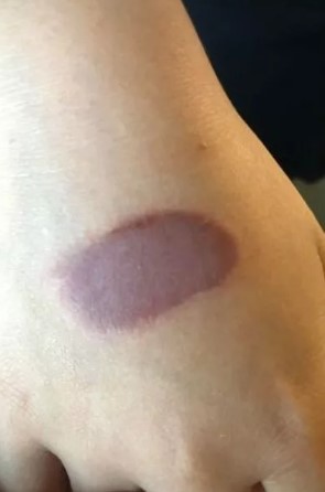 Menina de 10 anos pode precisar de cirurgia pl&aacute;stica – Foto: Reprodu&ccedil;&atilde;o/The Mirror