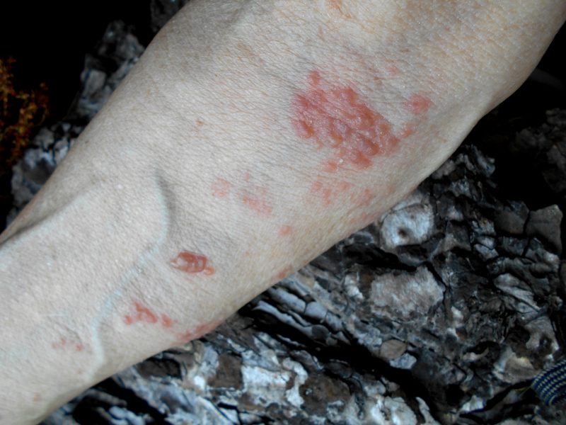 Skin lesions caused by the disease were photographed by an American –  Photo: George Wesley/flickr/Disclosure/ND