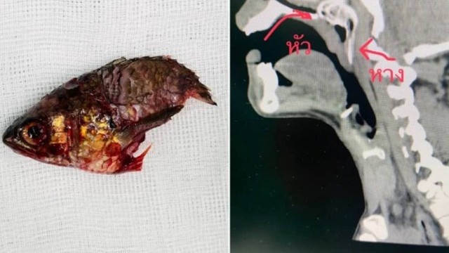 Animal ficou alojado e precisou ser retirado por cirurgia – Foto: Reprodu&ccedil;&atilde;o/Metro/ND