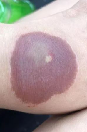 Desafio causou queimaduras na crian&ccedil;a – Foto: Reprodu&ccedil;&atilde;o/The Mirror