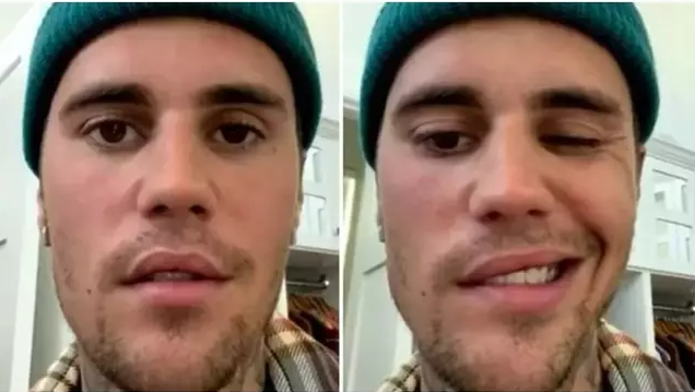 Singer Justin Bieber showed how one side of his face is completely paralyzed - Photo: Instagram reproduction @justinbieber/ND
