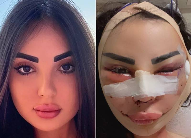 Modelo brasileira fica desfigurada após cirurgia plástica e denuncia maus-tratos de médico | ND Mais