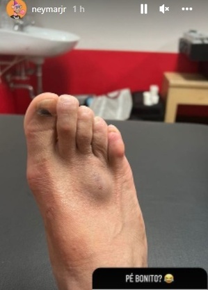 Neymar publicou em sua conta oficial a foto do seu p&eacute; ap&oacute;s dividida em treino – Foto: Reprodu&ccedil;&atilde;o/Internet/ND
